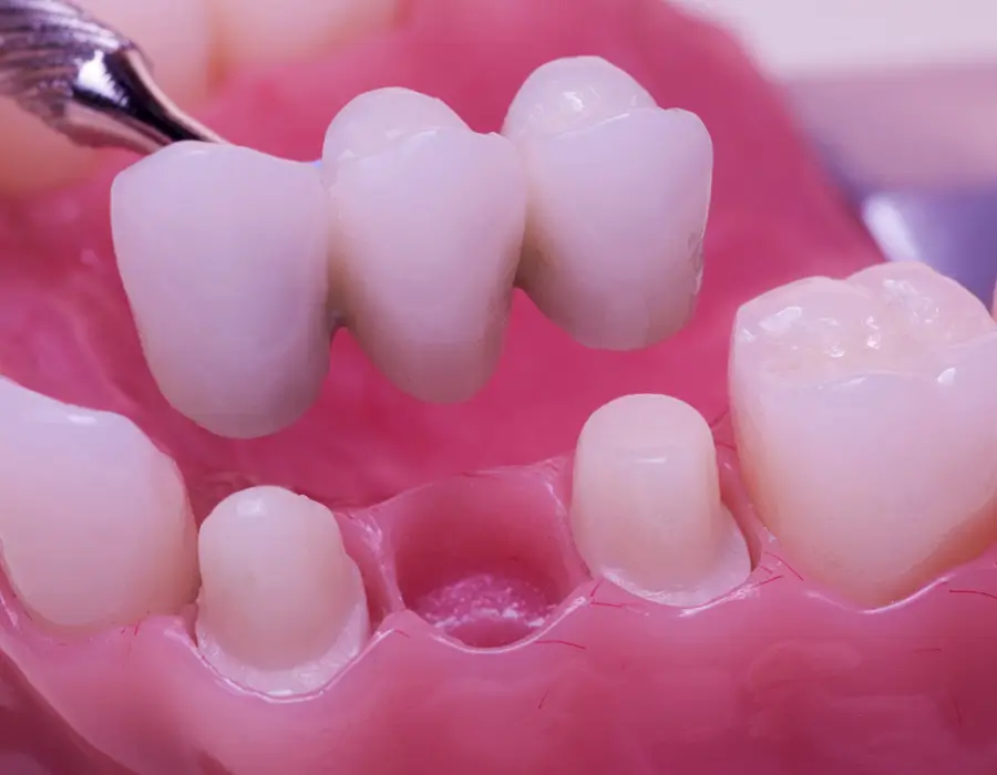 Benefit from Dental Bridges