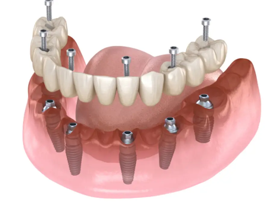 Fixed vs. Removable Implant Solutions